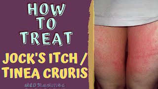 HOW TO TREAT JOCKS ITCH  TINEA CRURIS [upl. by Mallin466]