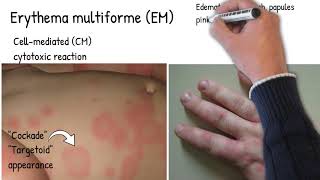 Erythema Multiform  Simply explained skin redness and rush pinkred ring around a pale center [upl. by Palumbo53]