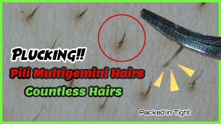 Plucking Pili Multigemini Hairs Countless Hairs 10 [upl. by Lustick]