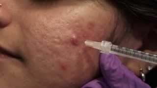 Watch amp Learn Intralesional injections [upl. by Dobrinsky]