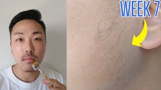 WEEK 7 MINOXIDIL BEARD GROWTH VELLUS HAIRS [upl. by Nysa]