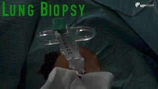 Kidney biopsy procedure [upl. by Aicert]