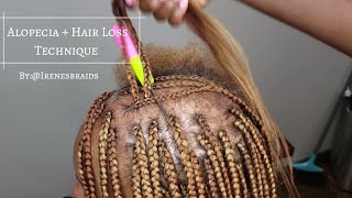 NEW TECHNIQUE ALOPECIA  HAIR LOSS BOX BRAIDS  IRENESBRAIDS [upl. by Ecidna]