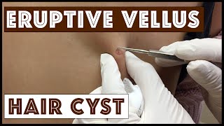 Unusual types of Cysts Eruptive Vellus Hair Cysts Part 1 in a Series [upl. by Broome]