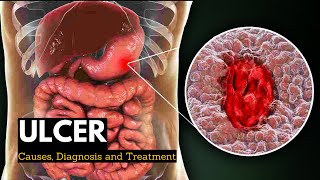 Ulcer Causes Signs and Symptoms Diagnosis and Treatment [upl. by Himelman]