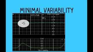 Topic 26 Intrapartum Fetal Surveillance [upl. by Delastre666]