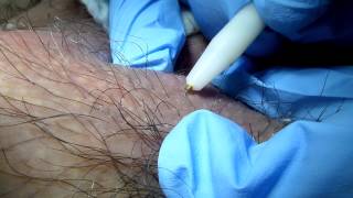 Hair Removal on Terminal Hair Electrolysis [upl. by Eehtomit622]