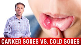 Canker Sores Vs Cold Sores – Dr Berg on Mouth Sores [upl. by Deste]